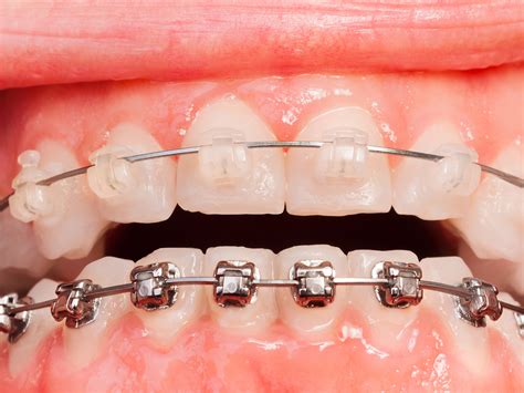 metal versus ceramic brackets|problems with ceramic braces.